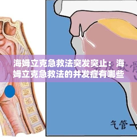 海姆立克急救法突發(fā)突止:海姆立克急救法的并發(fā)癥有哪些?