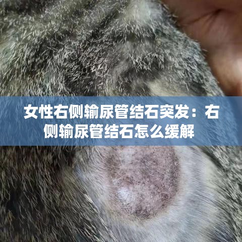 女性右側(cè)輸尿管結(jié)石突發(fā):右側(cè)輸尿管結(jié)石怎么緩解