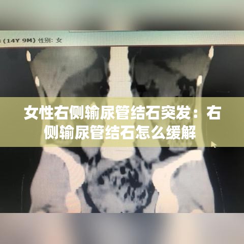 女性右側(cè)輸尿管結(jié)石突發(fā):右側(cè)輸尿管結(jié)石怎么緩解