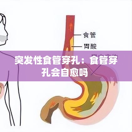 突發性食管穿孔:食管穿孔會自愈嗎